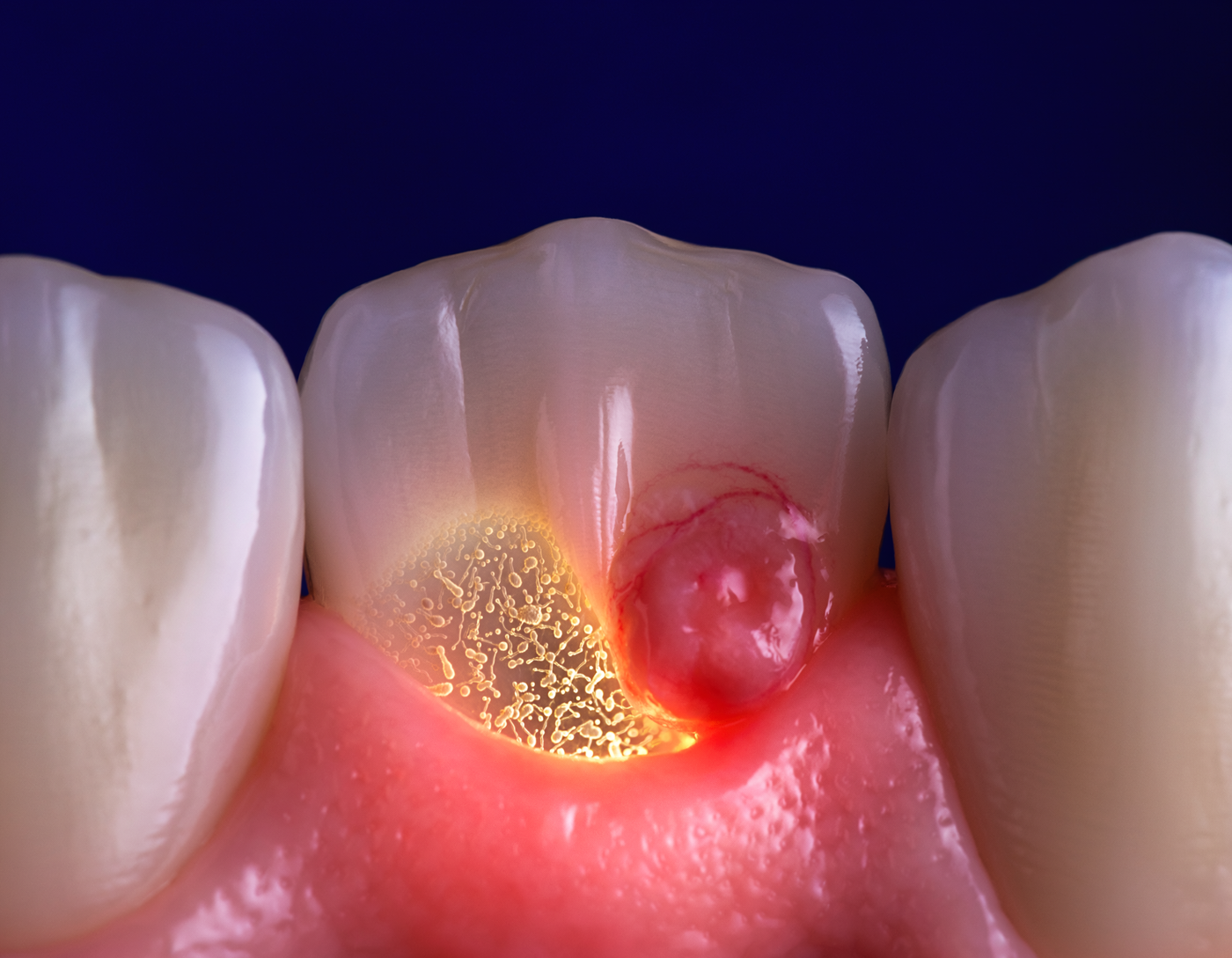 Bleeding Gums, Properly Explained