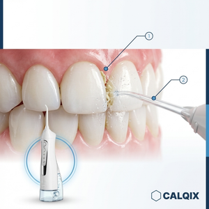 Diagram of dental cleaning process with CALQIX device labeled